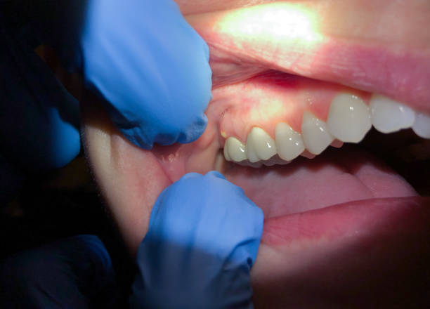 Best Emergency Wisdom Tooth Extraction in Wakeeney, KS